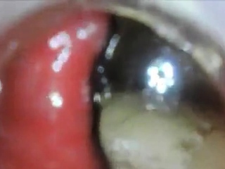 anal endoscope ass play from inside